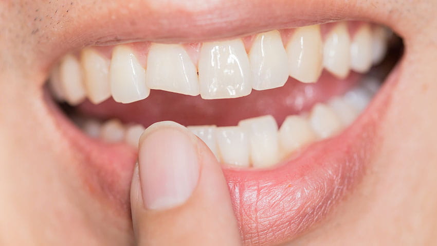 Kırık Diş Nasıl Tedavi Edilir?