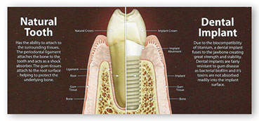 implant diş ve doğal diş