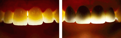 Zirkonyum Destekli Kaplama Diş ve Metal Destekli Kaplama Diş Farkı