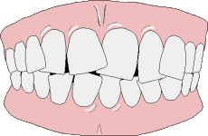 Çapraşık Dişler Nasıl Düzelir Animasyon